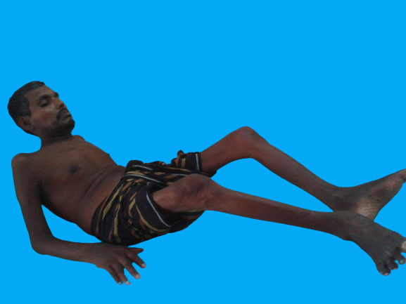 Ankylosing_Spondylitis