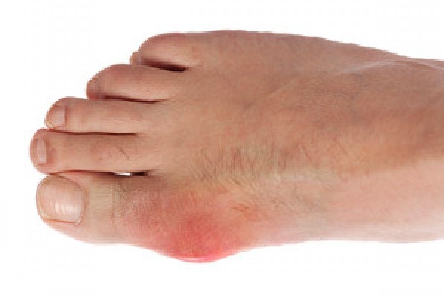 Gout